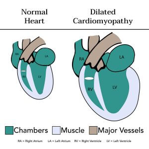 Normal Heart Vs. Dilated Cardiomyopathy Heart Infographic