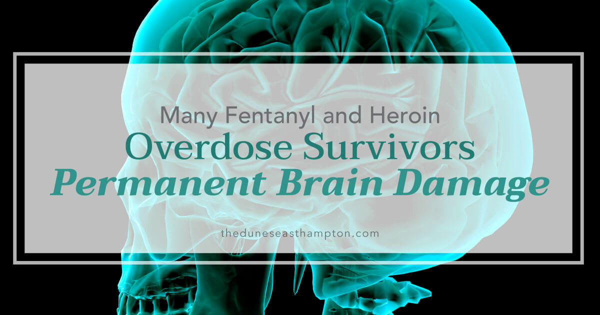 Many Fentanyl and Heroin Overdose Survivors Suffering Permanent Brain Damage